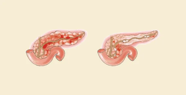 Pancreatitis: Acute vs. Chronic and How to Manage It